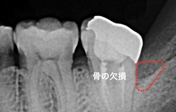 歯周病外科治療 | とりい歯科